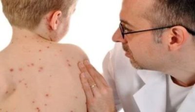 الأعراض والعلاج.. كل ما تحتاج معرفته عن الحصبة